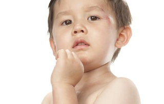 Penyakit Alergi Pada Anak | Alergi Anak | Alergi Pada Anak