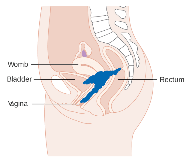 cervical-cancer-early-symptoms