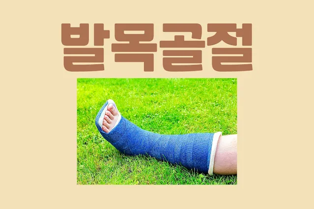 발목골절-치료기간-회복기간