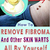 How To Remove Fibroma And Other Skin Warts All By Yourself?