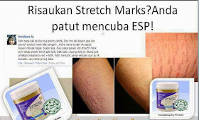 Cara Hilangkan Stretch Mark