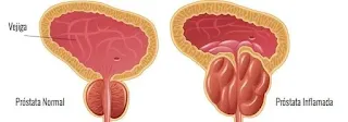 ¿Qué causa la próstata inflamada y cómo tratarla?
