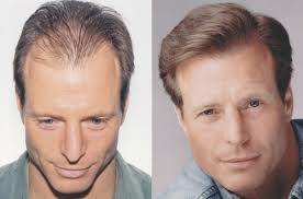 hair transplant in Islamabad