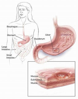 Ulcer Symptom Pictures