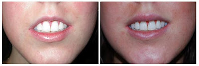 Lip Augmentation Before And After