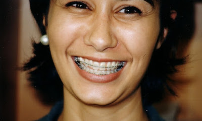 Niềng răng cho người lớn bằng phương pháp nào? 2