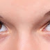 dark circles under eyes