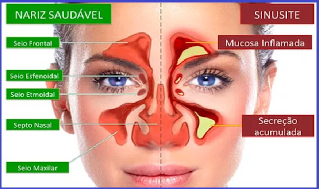     A Sinusite: quais são as principais causas, sintomas e como é o tratamento   A sinusite, também chamada pelos médicos de rinossinusite, é um processo inflamatório que atinge a mucosa do nariz e os seios da face. Apesar de ser bastante frequente entre a população, a doença é mais comum durante o inverno, época em que predomina o clima seco e frio, e pode ser pior nas crianças.  Vírus e bactérias podem causar sinusite  A rinossinusite pode ser causada por diversos fatores. “Pode ter causas alérgicas, virais, bacterianas ou fúngicas. Esses fatores provocam uma reação da mucosa nasal, levando a um edema e à obstrução dos orifícios que drenam as secreções naturalmente para dentro do nariz, acumulando essas secreções e gerando infecção local”, afirma a otorrinolaringologista Luísi Rabaioli.  O contato com a poeira e produtos químicos e até mesmo mudanças de tempo podem funcionar como fatores que desencadeiam a sinusite. Outros fatores de risco são alergias, tabagismo, baixa imunidade, mudanças frequentes de pressão atmosférica e alterações anatômicas, como desvio de septo.  Sinusite provoca dor na cabeça e tosse  A rinossinusite pode ser aguda ou crônica, mas os dois tipos têm sintomas semelhantes. A diferença entre eles é a duração das crises. “Os sintomas do quadro agudo costumam durar pelo menos 10 dias e, na forma crônica, as queixas são mais intensas e duradouras, presentes por mais de três meses”, distingue a médica.  Os sintomas da sinusite envolvem, principalmente, obstrução e secreção nasal, tosse e sensação de pressão e peso na cabeça. Segundo a especialista, os pacientes com o problema também podem ter febre, redução do olfato, abafamento da audição, dor no ouvido e no maxilar superior e cansaço.                                                                                                                                                A Sinusite: quais são as principais causas, sintomas e como é o tratamento   A sinusite, também chamada pelos médicos de rinossinusite, é um processo inflamatório que atinge a mucosa do nariz e os seios da face. Apesar de ser bastante frequente entre a população, a doença é mais comum durante o inverno, época em que predomina o clima seco e frio, e pode ser pior nas crianças.  Vírus e bactérias podem causar sinusite  A rinossinusite pode ser causada por diversos fatores. “Pode ter causas alérgicas, virais, bacterianas ou fúngicas. Esses fatores provocam uma reação da mucosa nasal, levando a um edema e à obstrução dos orifícios que drenam as secreções naturalmente para dentro do nariz, acumulando essas secreções e gerando infecção local”, afirma a otorrinolaringologista Luísi Rabaioli.  O contato com a poeira e produtos químicos e até mesmo mudanças de tempo podem funcionar como fatores que desencadeiam a sinusite. Outros fatores de risco são alergias, tabagismo, baixa imunidade, mudanças frequentes de pressão atmosférica e alterações anatômicas, como desvio de septo.  Sinusite provoca dor na cabeça e tosse  A rinossinusite pode ser aguda ou crônica, mas os dois tipos têm sintomas semelhantes. A diferença entre eles é a duração das crises. “Os sintomas do quadro agudo costumam durar pelo menos 10 dias e, na forma crônica, as queixas são mais intensas e duradouras, presentes por mais de três meses”, distingue a médica.  Os sintomas da sinusite envolvem, principalmente, obstrução e secreção nasal, tosse e sensação de pressão e peso na cabeça. Segundo a especialista, os pacientes com o problema também podem ter febre, redução do olfato, abafamento da audição, dor no ouvido e no maxilar superior e cansaço.  Tosse da sinusite pode piorar à noite  Nos casos crônicos, a tosse tende a piorar durante a manhã e a noite, mas se agrava principalmente quando o paciente se deita. Estes quadros da infecção são mais incomuns e estão muitas vezes associados a outros problemas de saúde, como rinite, asma e outras doenças alérgicas.  O diagnóstico da sinusite é feito por meio de consulta com um especialista e de exames. “Durante o exame físico, o otorrinolaringologista encontra alterações e evidências para o diagnóstico. O uso de radiografias ou tomografias não deve ser feito de rotina, mas pode ajudar o médico nos casos de recidivas ou complicações”, afirma Luísi.  Diagnóstico precoce aumenta chances de cura da sinusite  Quanto antes o diagnóstico for feito, melhor será para o paciente. “A rinossinusite tem cura! O tratamento quase sempre é clínico e nem sempre antibióticos são necessários. Podemos utilizar sprays nasais e medicações por via oral, nunca esquecendo da lavagem nasal com soro fisiológico”, diz a otorrinolaringologista.  Entre os medicamentos indicados estão corticosteroides e descongestionantes nasais. A sinusite aguda não costuma deixar sequelas, de acordo com a profissional, mas quadros graves ou casos em que o tratamento clínico não é suficiente podem precisar de cirurgia. O procedimento é realizado por dentro do nariz, sem cortes externos, melhorando a passagem do ar pelos seios da face                                                                                                                                            A Sinusite: quais são as principais causas, sintomas e como é o tratamento   A sinusite, também chamada pelos médicos de rinossinusite, é um processo inflamatório que atinge a mucosa do nariz e os seios da face. Apesar de ser bastante frequente entre a população, a doença é mais comum durante o inverno, época em que predomina o clima seco e frio, e pode ser pior nas crianças.  Vírus e bactérias podem causar sinusite  A rinossinusite pode ser causada por diversos fatores. “Pode ter causas alérgicas, virais, bacterianas ou fúngicas. Esses fatores provocam uma reação da mucosa nasal, levando a um edema e à obstrução dos orifícios que drenam as secreções naturalmente para dentro do nariz, acumulando essas secreções e gerando infecção local”, afirma a otorrinolaringologista Luísi Rabaioli.  O contato com a poeira e produtos químicos e até mesmo mudanças de tempo podem funcionar como fatores que desencadeiam a sinusite. Outros fatores de risco são alergias, tabagismo, baixa imunidade, mudanças frequentes de pressão atmosférica e alterações anatômicas, como desvio de septo.  Sinusite provoca dor na cabeça e tosse  A rinossinusite pode ser aguda ou crônica, mas os dois tipos têm sintomas semelhantes. A diferença entre eles é a duração das crises. “Os sintomas do quadro agudo costumam durar pelo menos 10 dias e, na forma crônica, as queixas são mais intensas e duradouras, presentes por mais de três meses”, distingue a médica.  Os sintomas da sinusite envolvem, principalmente, obstrução e secreção nasal, tosse e sensação de pressão e peso na cabeça. Segundo a especialista, os pacientes com o problema também podem ter febre, redução do olfato, abafamento da audição, dor no ouvido e no maxilar superior e cansaço.  Tosse da sinusite pode piorar à noite  Nos casos crônicos, a tosse tende a piorar durante a manhã e a noite, mas se agrava principalmente quando o paciente se deita. Estes quadros da infecção são mais incomuns e estão muitas vezes associados a outros problemas de saúde, como rinite, asma e outras doenças alérgicas.  O diagnóstico da sinusite é feito por meio de consulta com um especialista e de exames. “Durante o exame físico, o otorrinolaringologista encontra alterações e evidências para o diagnóstico. O uso de radiografias ou tomografias não deve ser feito de rotina, mas pode ajudar o médico nos casos de recidivas ou complicações”, afirma Luísi.  Diagnóstico precoce aumenta chances de cura da sinusite  Quanto antes o diagnóstico for feito, melhor será para o paciente. “A rinossinusite tem cura! O tratamento quase sempre é clínico e nem sempre antibióticos são necessários. Podemos utilizar sprays nasais e medicações por via oral, nunca esquecendo da lavagem nasal com soro fisiológico”, diz a otorrinolaringologista.  Entre os medicamentos indicados estão corticosteroides e descongestionantes nasais. A sinusite aguda não costuma deixar sequelas, de acordo com a profissional, mas quadros graves ou casos em que o tratamento clínico não é suficiente podem precisar de cirurgia. O procedimento é realizado por dentro do nariz, sem cortes externos, melhorando a passagem do ar pelos seios da face