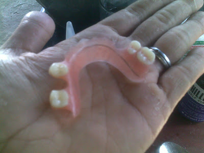 Contoh Foto Gigi Palsu Lepas Pasang new S A S Dental
