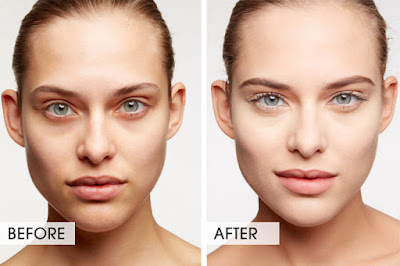 Treatment of dark circles around eyes
