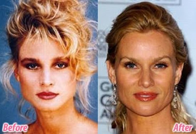 celebrity plastic surgery