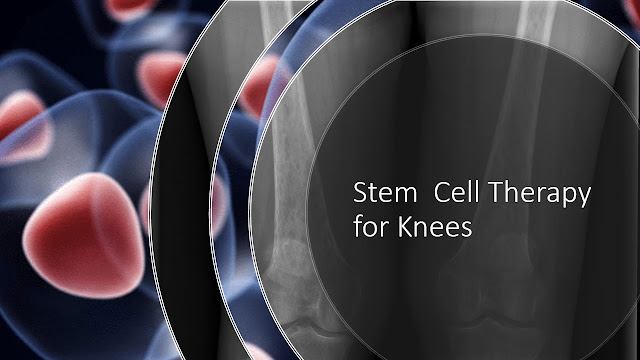 stem cell therapy for knees