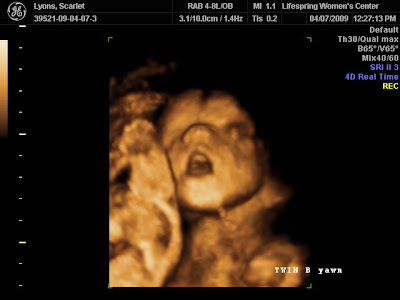 3D Ultrasound at 23 Weeks