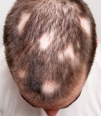 Hair Yeast Infection