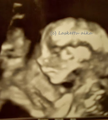 sikiö vauva ultrakuva ultraääni rakenneultra