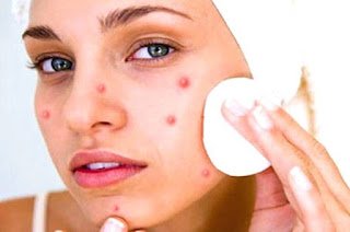 How To Remove Pimples