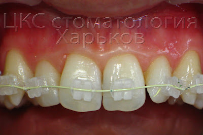 Внешний вид керамической брекет системы
