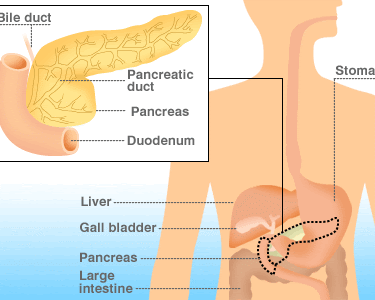 Pancreatic Cancer & Treatment
