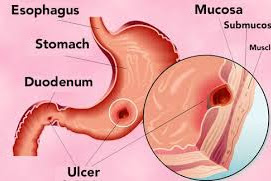 تعرفوا على أسباب الإصابة بقرحة المعدة و الاثني عشر و طرق الوقاية منها