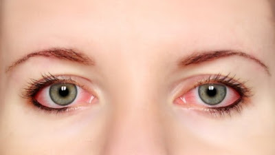 Penyebab Dan Cara Menghilangkan Bercak Merah Pada Mata Seperti Darah Beku Mengumpal