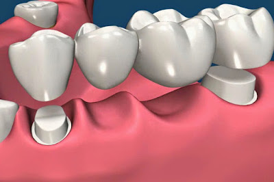 Cách vệ sinh cầu răng sứ theo hướng dẫn của nha sĩ-1