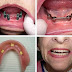 Mất hết răng phải cấy ghép bao nhiêu răng?