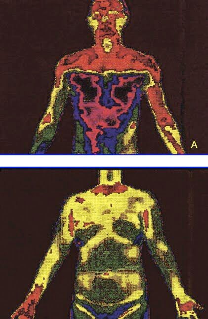 Digital infrared thermal image after T2 sympathicotomy or T3 ramicotomy