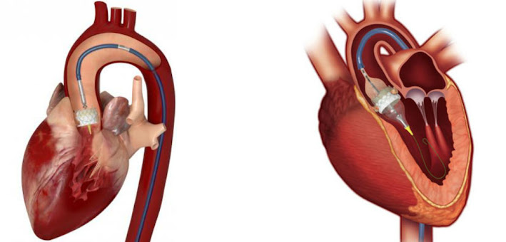 Transcatheter Heart Valve