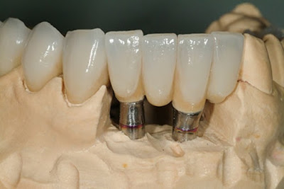 Cấy ghép implant răng hàm giá bao nhiêu? 1