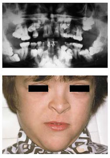 Cleidocranial Dysplasia