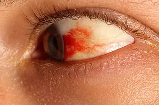 What Is Subconjunctival Hemorrhage (Broken Blood Vessel In Eye)