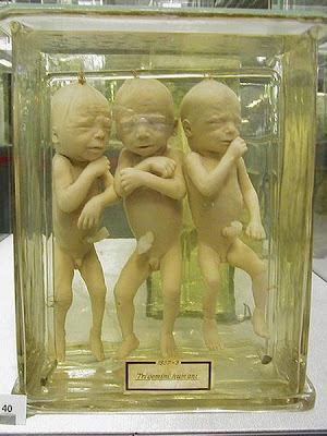 gambar kelainan bayi, museum bayi mengerikan, bayi abnormail, manusia aneh, gambar foto menyeramkan