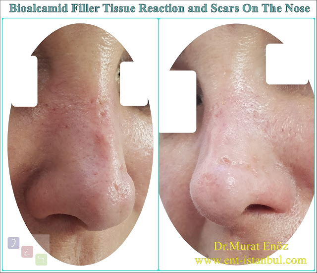 Damages of fillers containing polyalkylimide bioalcamid,Delayed immune response and tissue reaction due to permanent dermal fillers,Damages of permanent nose filler,Risks of permanent nose fillers,