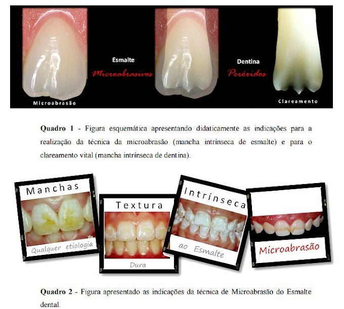 PDF: Clareamento de Dentes Vitais com Peróxido de Carbamida