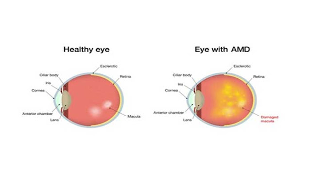 Mencegah AMD (Age-Related Macular Degeneration)