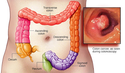 Inilah Cara Alami Mengobati Kanker Usus Yang Terbukti Ampuh Dan Efektif