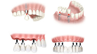 Cấu tạo của răng implant -1