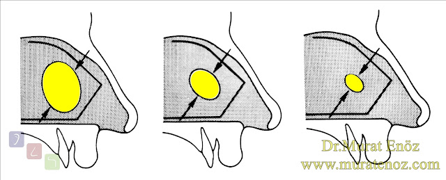 Extracorporeal septum perforation closure in Istanbul - Extracorporeal septum perforation closure in Turkey - Extracorporeal closure of nasal septal perforations subcutaneous tissue - Combining rhinoplasty with extracorporeal septal perforation repair - Repair of nasal septum Perforation