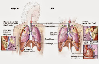 Types Of Most Common Cancer,Early Skin Cancer,Primary Liver Cancer,Most Common Cancer Types