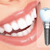 Cấy ghép implant có tốt không?