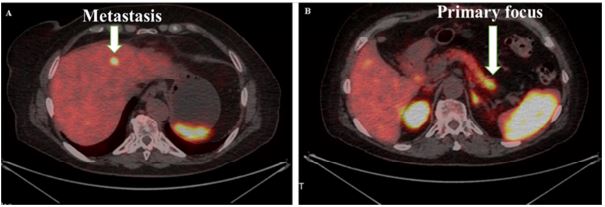 The role of Pet-Ct in neuroendocrine tumors without an identified primary focus: A case report and review