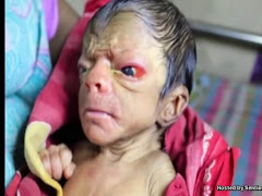 Gempar Bayi Luarbiasa Lahir Di Bangladesh Menyerupai Lelaki Tua!