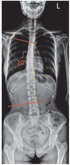 Após realização do exame, a radiografia evidenciou, na incidência anteroposterior (AP) do tronco, curvatura lateral da coluna vertebral (ângulo de Cobb de 20°) e Risser 4, conforme figura a seguir.