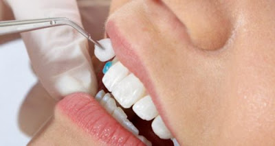 Nguyên nhân răng bọc sứ bị lung lay 1