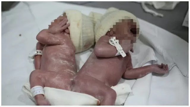 Gêmeos nascem unidos por pele e músculos do quadril no Paraná; caso é considerado raro, diz médica