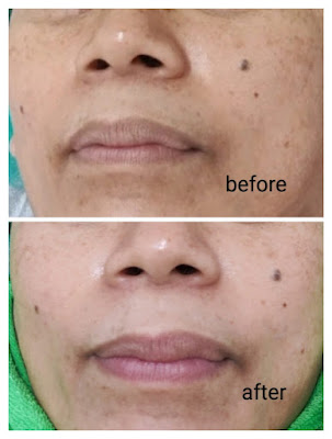 before after treatment klinik kecantikan di samarinda zap clinic