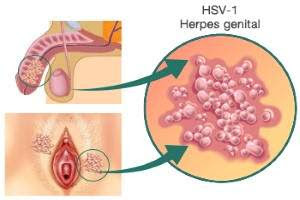 Herpes Genital: Pemeriksaan & Cara Menularnya