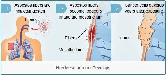 Causes and Risk Factors Mesothelioma
