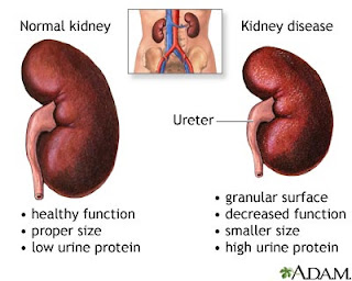 high protein diet risks for kidney disease