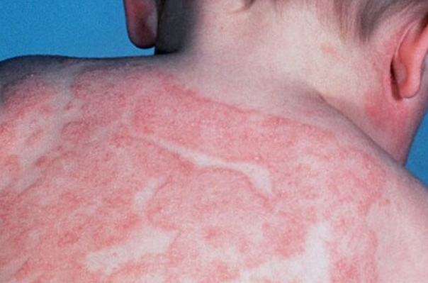ما هو التهاب الجلد التأتبي atopic dermatitis